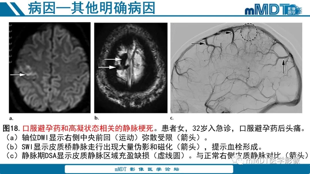 影像PPT - 【PPT】青年缺血性脑卒中:影像学综述-59 影像PPT - 【PPT】青年缺血性脑卒中:影像学综述-59