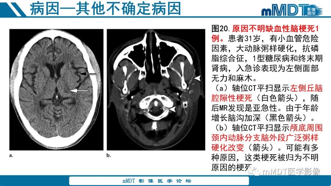 影像PPT - 【PPT】青年缺血性脑卒中:影像学综述-63 影像PPT - 【PPT】青年缺血性脑卒中:影像学综述-63