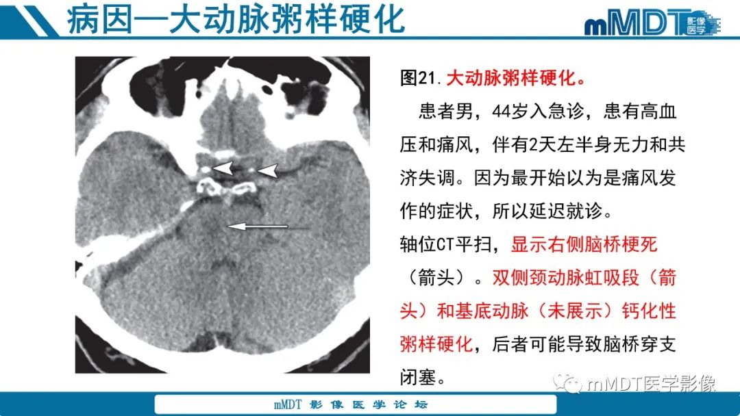 影像PPT - 【PPT】青年缺血性脑卒中:影像学综述-67 影像PPT - 【PPT】青年缺血性脑卒中:影像学综述-67