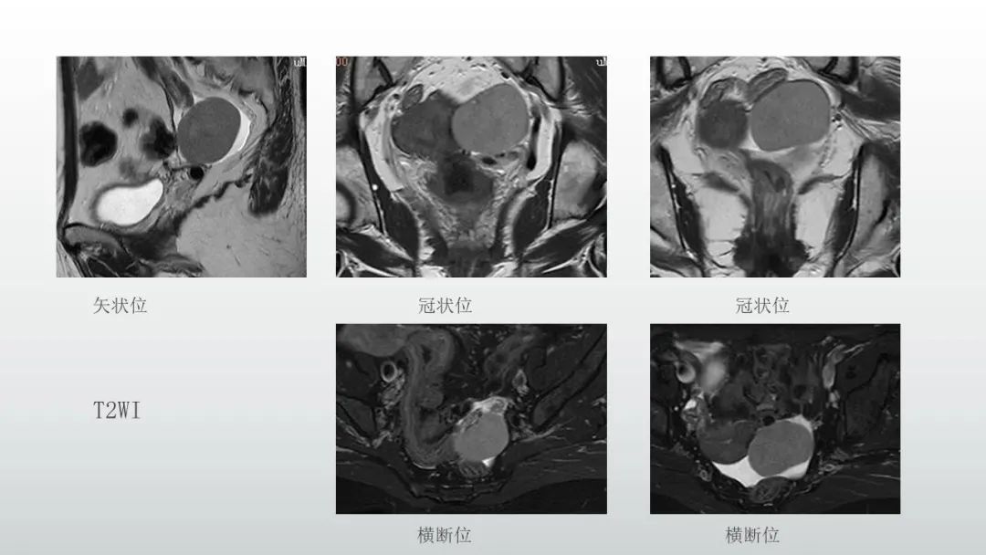 影像PPT - 【病例】卵巢浆细胞瘤1例MR影像-2