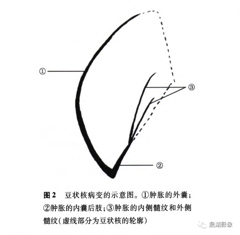 影像PPT - 豆状核叉状征-3 影像PPT - 豆状核叉状征-3