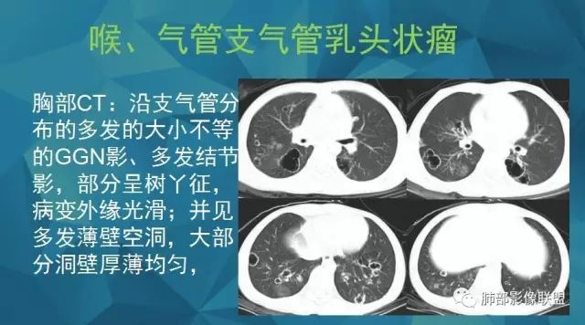 影像PPT - 【PPT】气管支气管乳头状瘤病-27 影像PPT - 【PPT】气管支气管乳头状瘤病-27