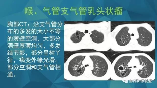 影像PPT - 【PPT】气管支气管乳头状瘤病-28 影像PPT - 【PPT】气管支气管乳头状瘤病-28