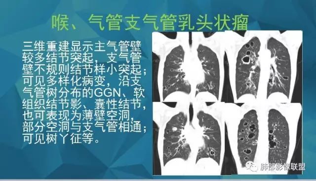 影像PPT - 【PPT】气管支气管乳头状瘤病-29 影像PPT - 【PPT】气管支气管乳头状瘤病-29