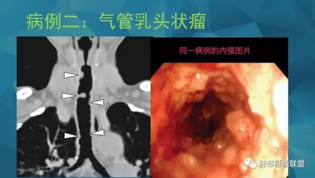 影像PPT - 【PPT】气管支气管乳头状瘤病-33 影像PPT - 【PPT】气管支气管乳头状瘤病-33