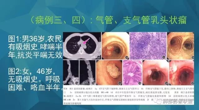 影像PPT - 【PPT】气管支气管乳头状瘤病-34 影像PPT - 【PPT】气管支气管乳头状瘤病-34