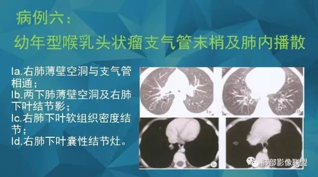 影像PPT - 【PPT】气管支气管乳头状瘤病-37 影像PPT - 【PPT】气管支气管乳头状瘤病-37