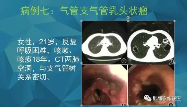 影像PPT - 【PPT】气管支气管乳头状瘤病-38 影像PPT - 【PPT】气管支气管乳头状瘤病-38