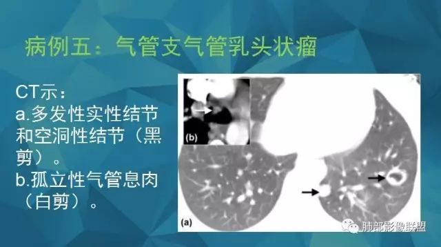 影像PPT - 【PPT】气管支气管乳头状瘤病-36 影像PPT - 【PPT】气管支气管乳头状瘤病-36