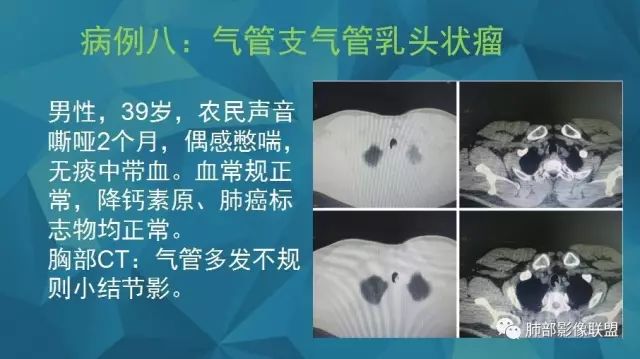 影像PPT - 【PPT】气管支气管乳头状瘤病-39 影像PPT - 【PPT】气管支气管乳头状瘤病-39