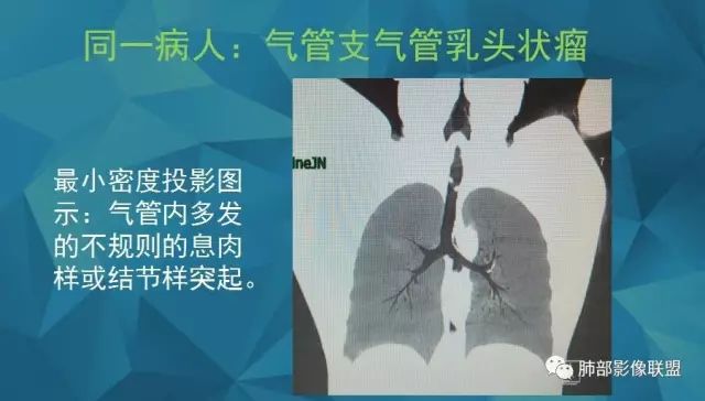 影像PPT - 【PPT】气管支气管乳头状瘤病-40 影像PPT - 【PPT】气管支气管乳头状瘤病-40