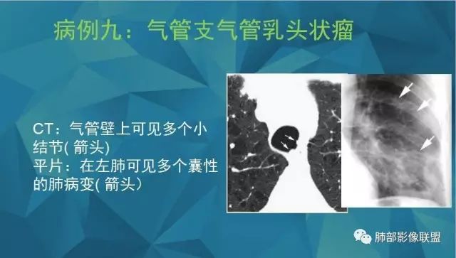 影像PPT - 【PPT】气管支气管乳头状瘤病-41 影像PPT - 【PPT】气管支气管乳头状瘤病-41