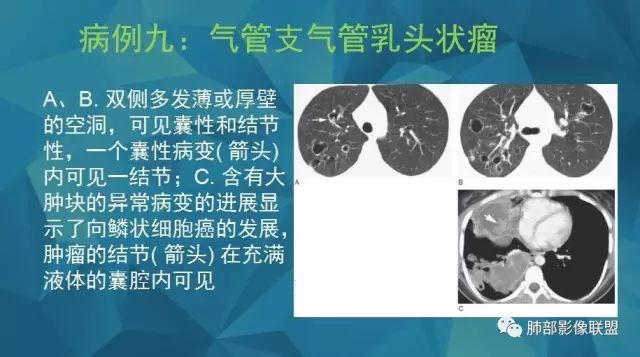 影像PPT - 【PPT】气管支气管乳头状瘤病-42 影像PPT - 【PPT】气管支气管乳头状瘤病-42