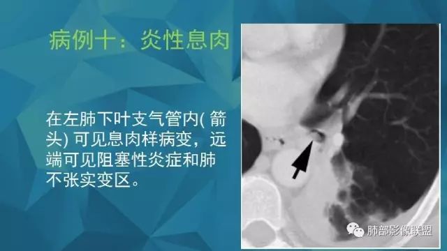 影像PPT - 【PPT】气管支气管乳头状瘤病-44 影像PPT - 【PPT】气管支气管乳头状瘤病-44