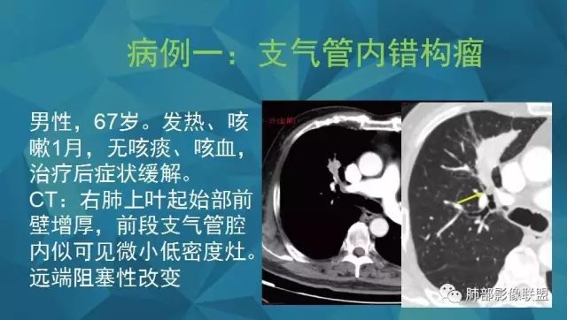 影像PPT - 【PPT】气管支气管乳头状瘤病-50 影像PPT - 【PPT】气管支气管乳头状瘤病-50