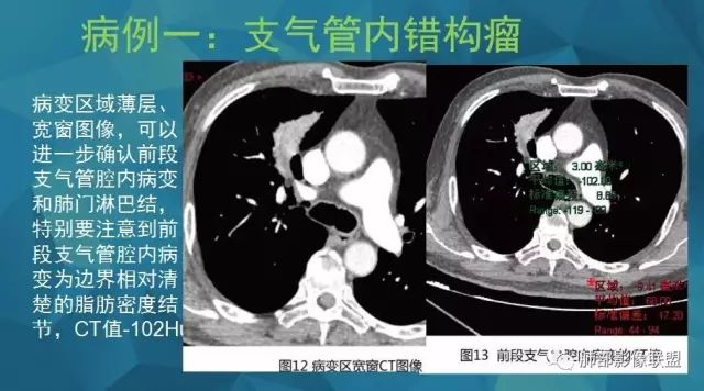 影像PPT - 【PPT】气管支气管乳头状瘤病-51 影像PPT - 【PPT】气管支气管乳头状瘤病-51