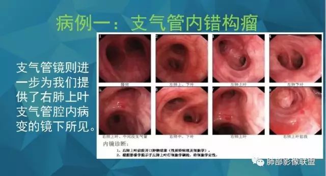 影像PPT - 【PPT】气管支气管乳头状瘤病-52 影像PPT - 【PPT】气管支气管乳头状瘤病-52