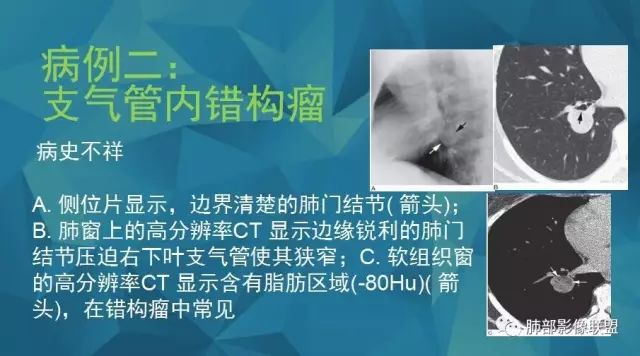 影像PPT - 【PPT】气管支气管乳头状瘤病-55 影像PPT - 【PPT】气管支气管乳头状瘤病-55