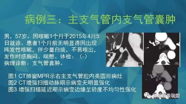 影像PPT - 【PPT】气管支气管乳头状瘤病-57 影像PPT - 【PPT】气管支气管乳头状瘤病-57