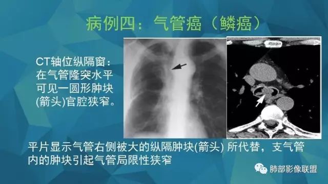 影像PPT - 【PPT】气管支气管乳头状瘤病-59 影像PPT - 【PPT】气管支气管乳头状瘤病-59
