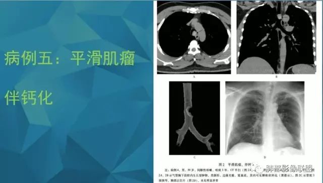 影像PPT - 【PPT】气管支气管乳头状瘤病-61 影像PPT - 【PPT】气管支气管乳头状瘤病-61