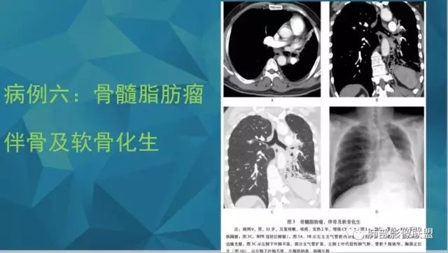 影像PPT - 【PPT】气管支气管乳头状瘤病-62 影像PPT - 【PPT】气管支气管乳头状瘤病-62