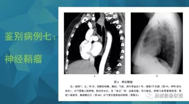 影像PPT - 【PPT】气管支气管乳头状瘤病-63 影像PPT - 【PPT】气管支气管乳头状瘤病-63