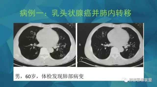 影像PPT - 【PPT】气管支气管乳头状瘤病-65 影像PPT - 【PPT】气管支气管乳头状瘤病-65