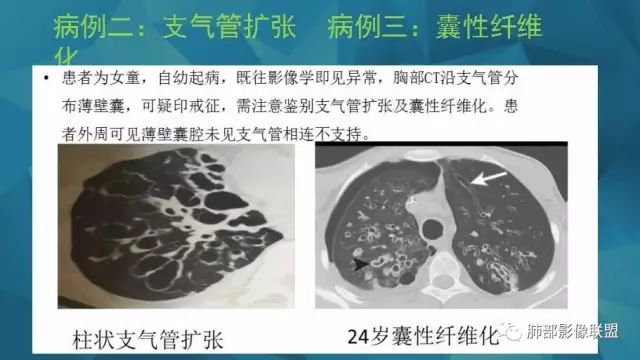 影像PPT - 【PPT】气管支气管乳头状瘤病-66 影像PPT - 【PPT】气管支气管乳头状瘤病-66