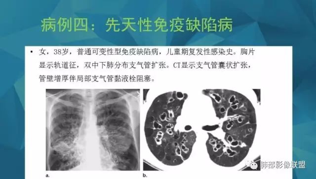 影像PPT - 【PPT】气管支气管乳头状瘤病-67 影像PPT - 【PPT】气管支气管乳头状瘤病-67