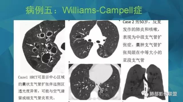 影像PPT - 【PPT】气管支气管乳头状瘤病-68 影像PPT - 【PPT】气管支气管乳头状瘤病-68
