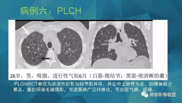 影像PPT - 【PPT】气管支气管乳头状瘤病-69 影像PPT - 【PPT】气管支气管乳头状瘤病-69