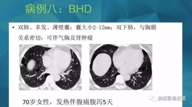 影像PPT - 【PPT】气管支气管乳头状瘤病-71 影像PPT - 【PPT】气管支气管乳头状瘤病-71