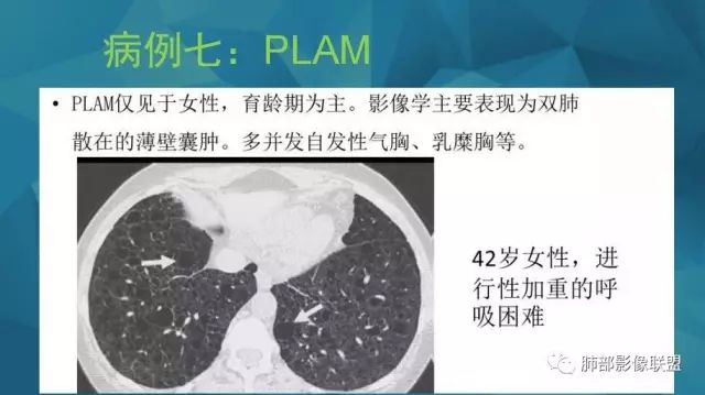 影像PPT - 【PPT】气管支气管乳头状瘤病-70 影像PPT - 【PPT】气管支气管乳头状瘤病-70