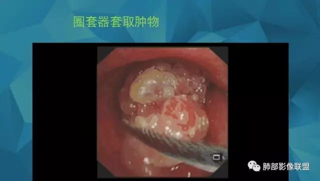 影像PPT - 【PPT】气管支气管乳头状瘤病-81 影像PPT - 【PPT】气管支气管乳头状瘤病-81