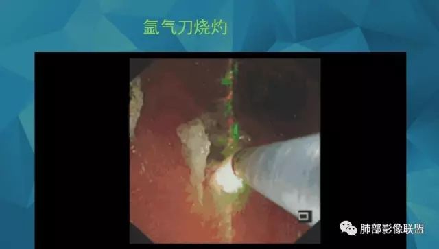 影像PPT - 【PPT】气管支气管乳头状瘤病-82 影像PPT - 【PPT】气管支气管乳头状瘤病-82