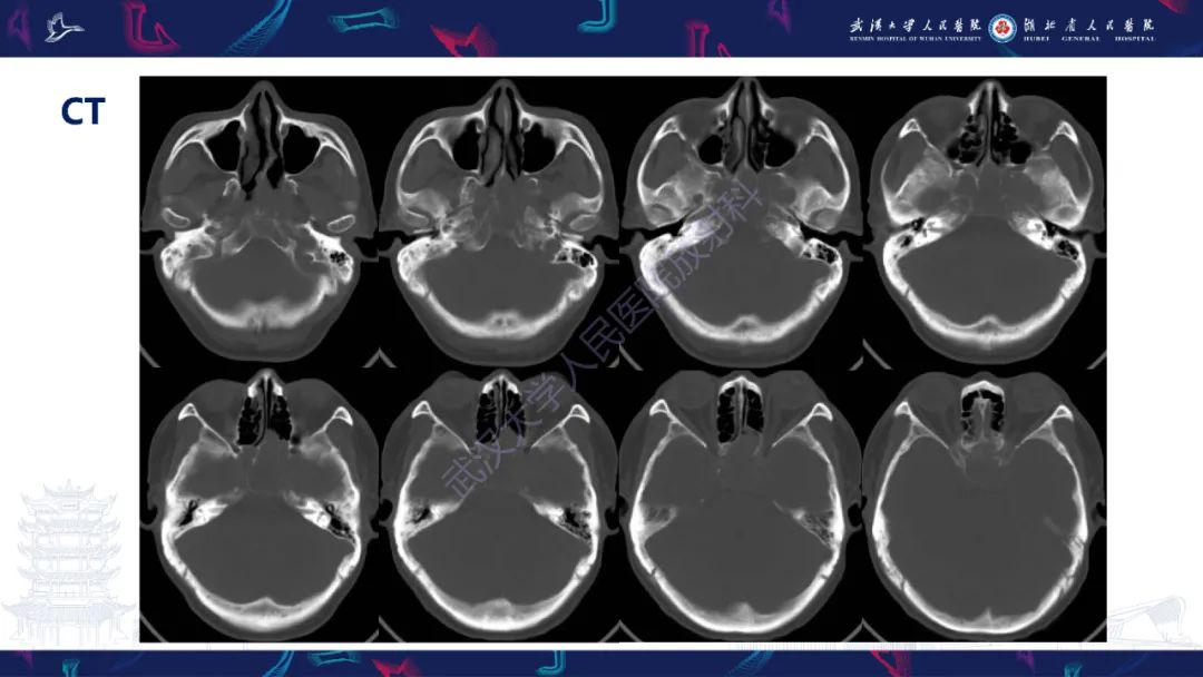 影像PPT - 【PPT】斜坡肿瘤影像诊断-4