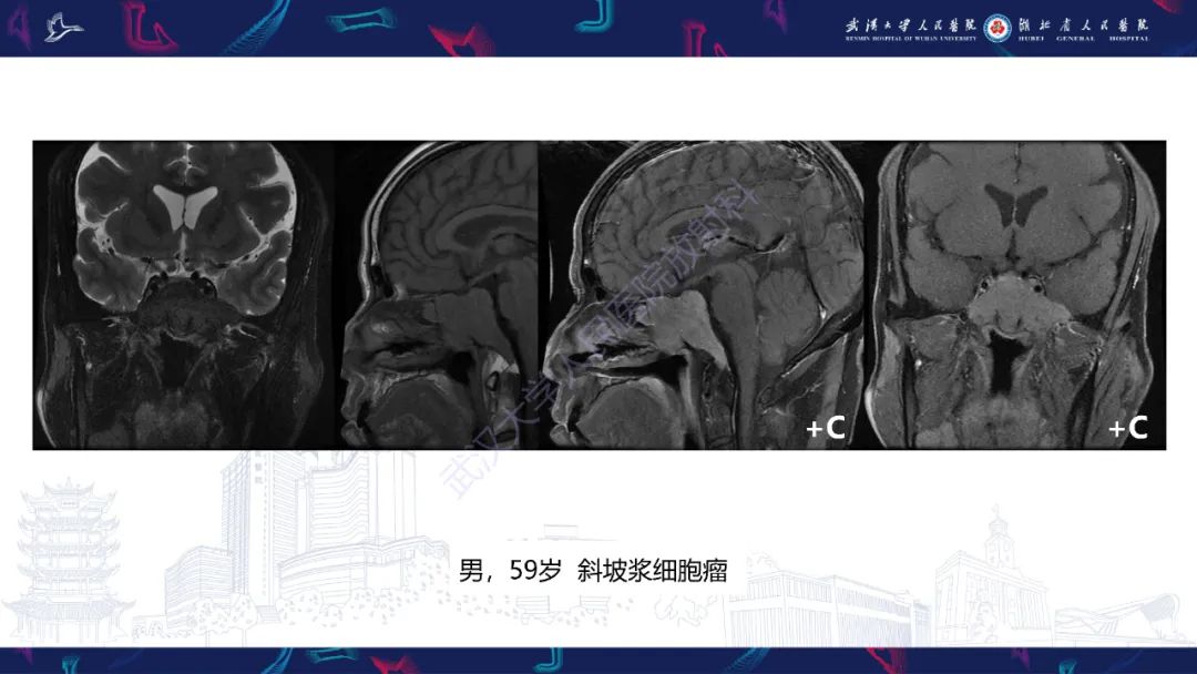影像PPT - 【PPT】斜坡肿瘤影像诊断-10