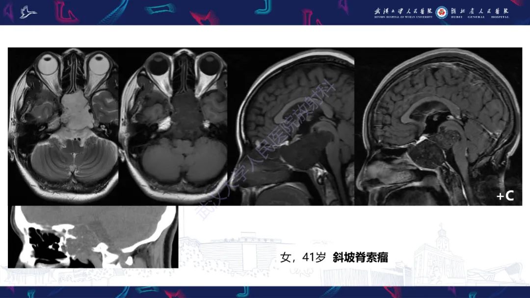 影像PPT - 【PPT】斜坡肿瘤影像诊断-13