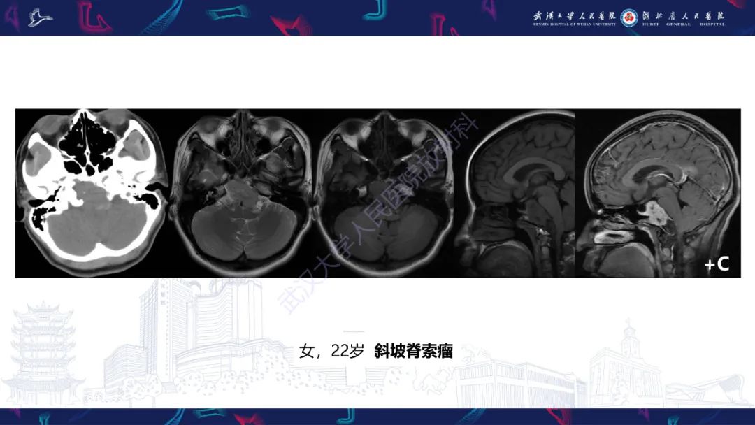 影像PPT - 【PPT】斜坡肿瘤影像诊断-14