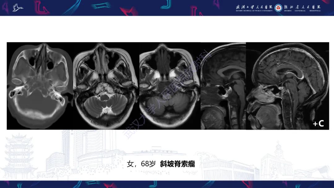 影像PPT - 【PPT】斜坡肿瘤影像诊断-15