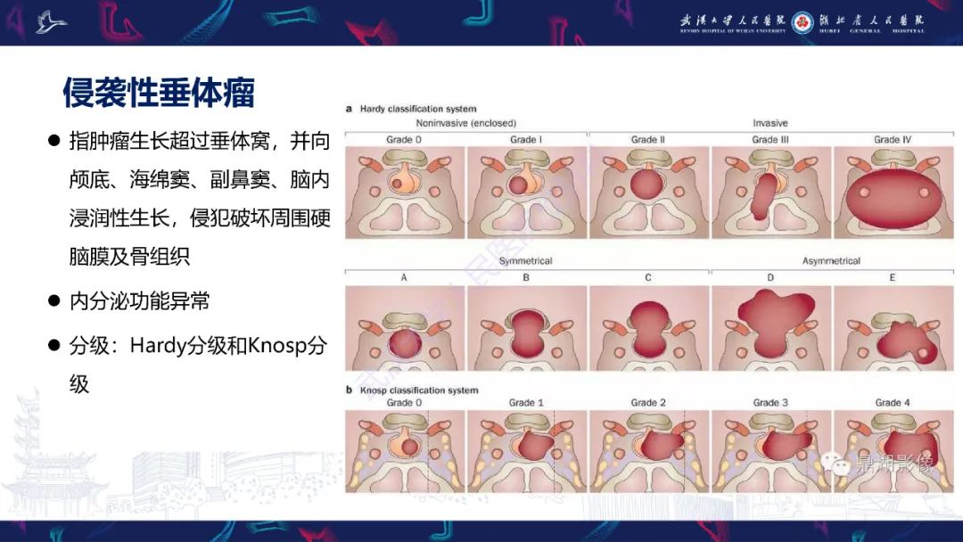 影像PPT - 【PPT】斜坡肿瘤影像诊断-16