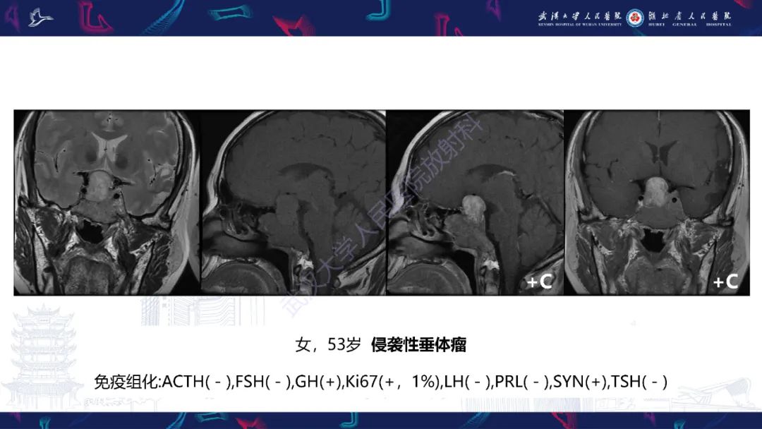 影像PPT - 【PPT】斜坡肿瘤影像诊断-18