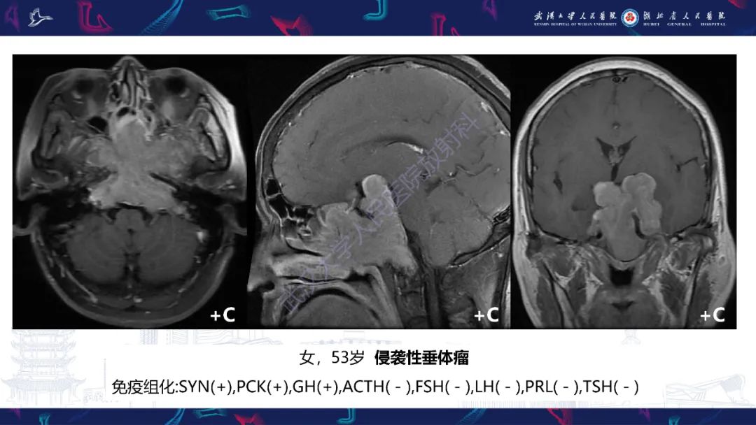 影像PPT - 【PPT】斜坡肿瘤影像诊断-19