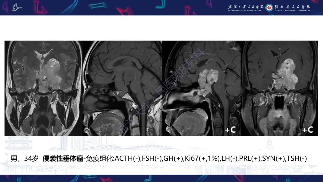 影像PPT - 【PPT】斜坡肿瘤影像诊断-20