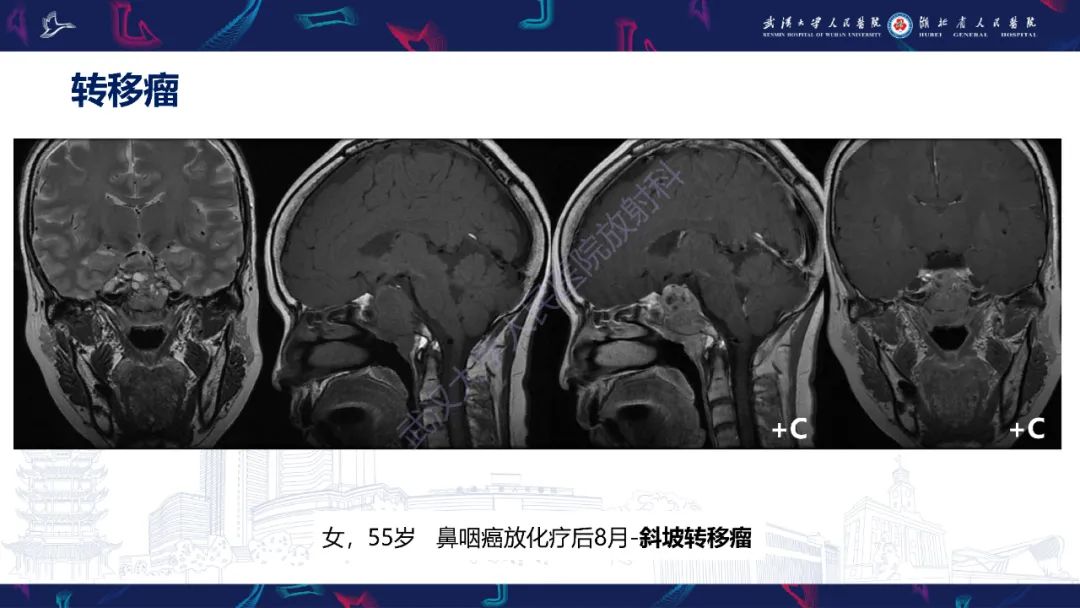 影像PPT - 【PPT】斜坡肿瘤影像诊断-21