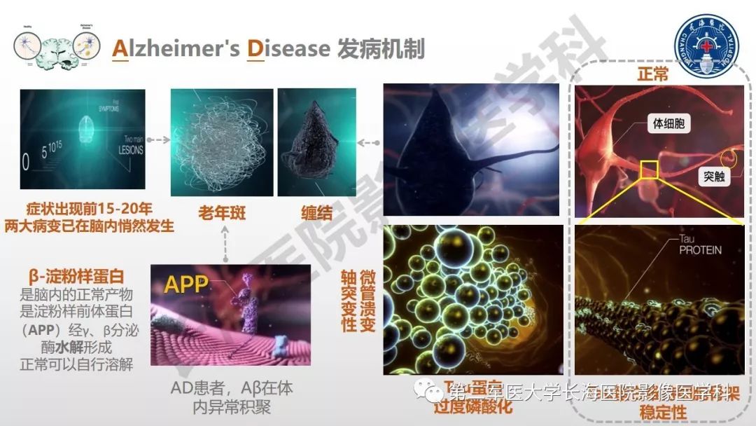 影像PPT - 【PPT】阿尔兹海默症 ——临床与影像-6