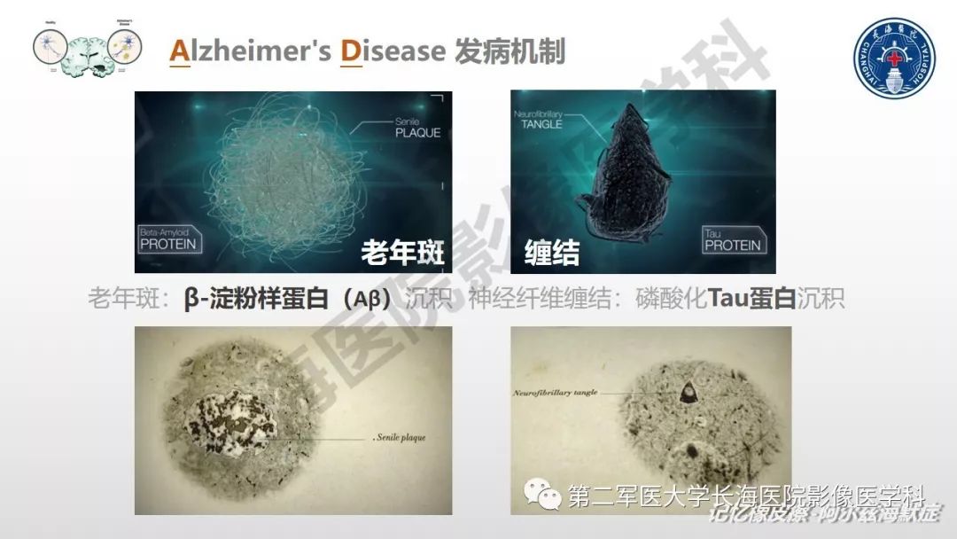 影像PPT - 【PPT】阿尔兹海默症 ——临床与影像-7