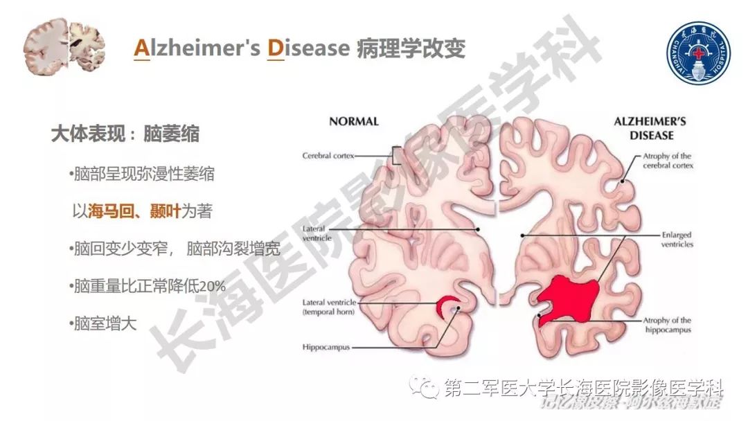 影像PPT - 【PPT】阿尔兹海默症 ——临床与影像-9