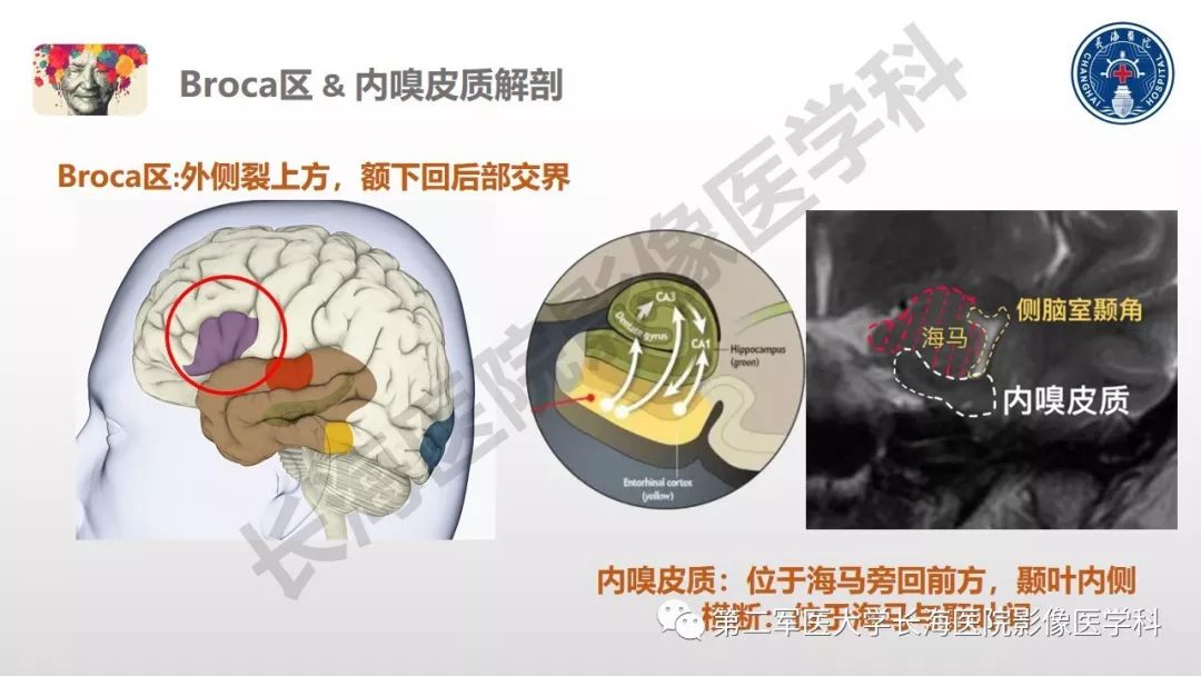 影像PPT - 【PPT】阿尔兹海默症 ——临床与影像-11